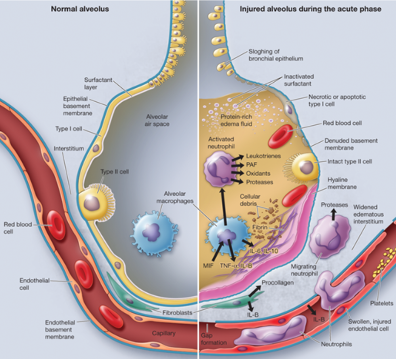 Hội chứng suy hô hấp cấp tính (ARDS)