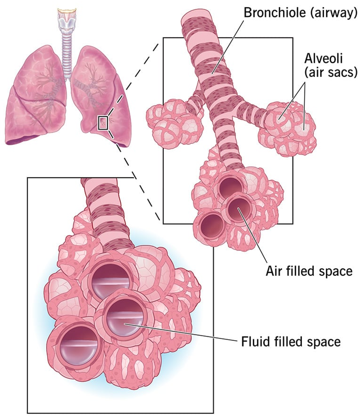 Cardiogenic pulmonary edema