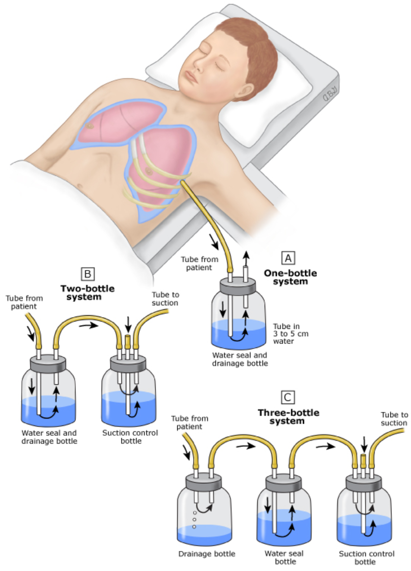 Sơ đồ hệ thống dẫn lưu 1 bình, 2 bình và 3 bình