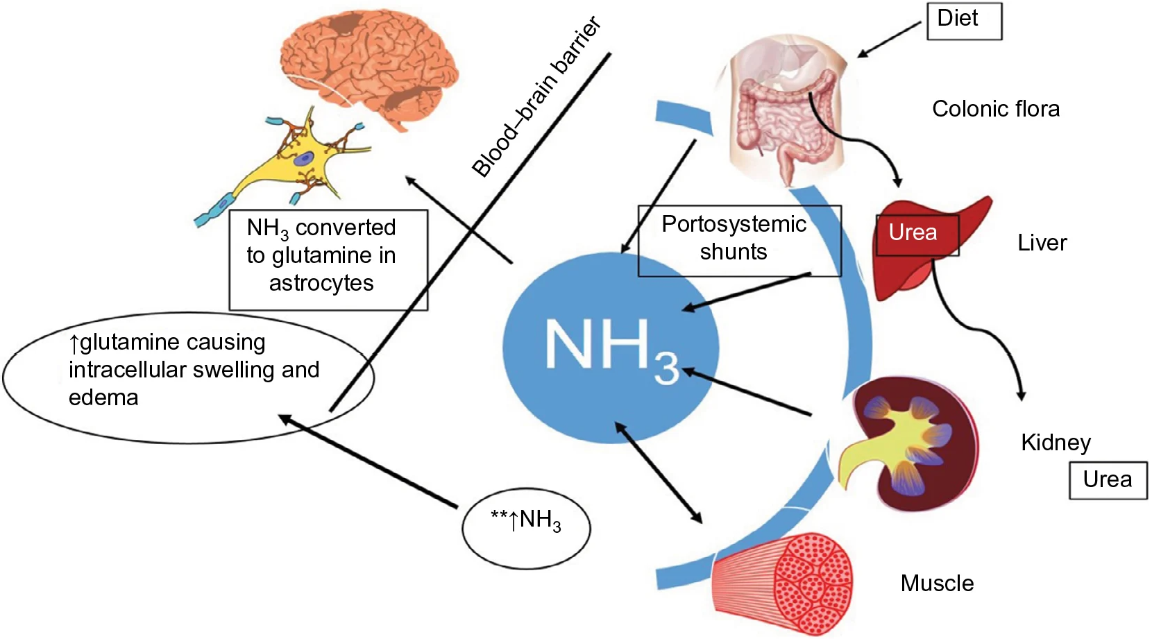 Suy gan cấp nặng, hôn mê gan