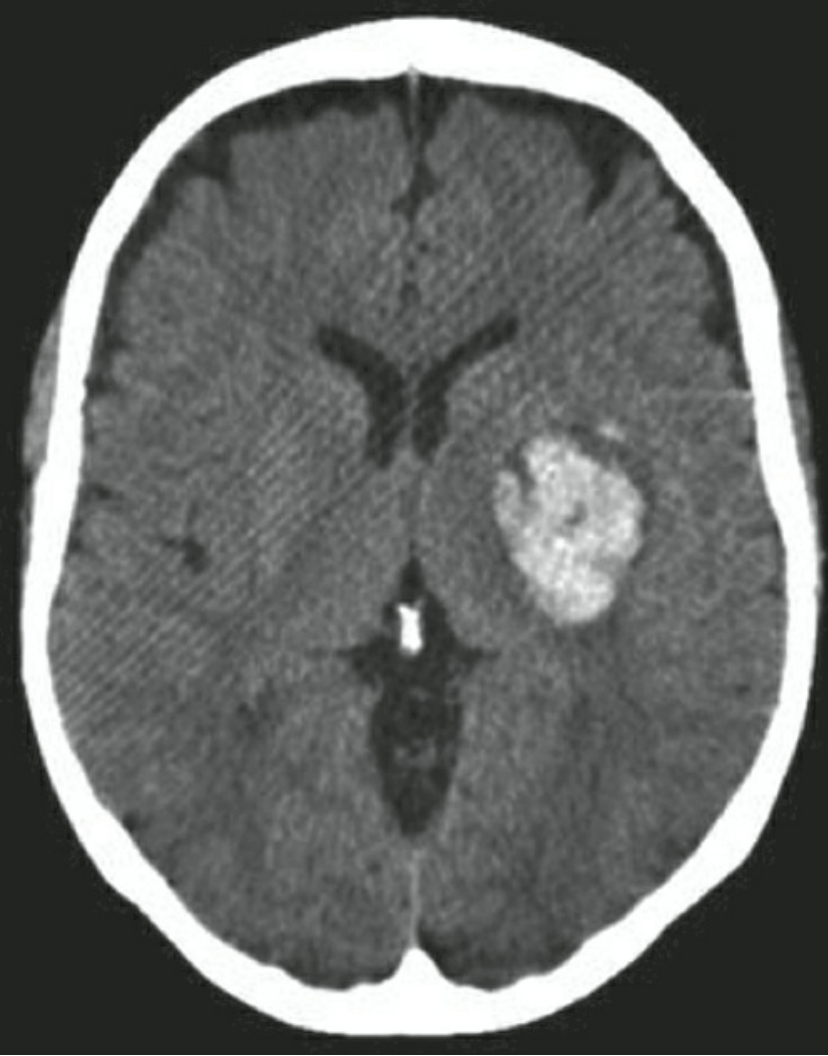 Xuất huyết trong não(ICH)
