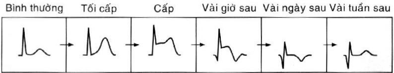 Diễn tiến NMCT trên ECG