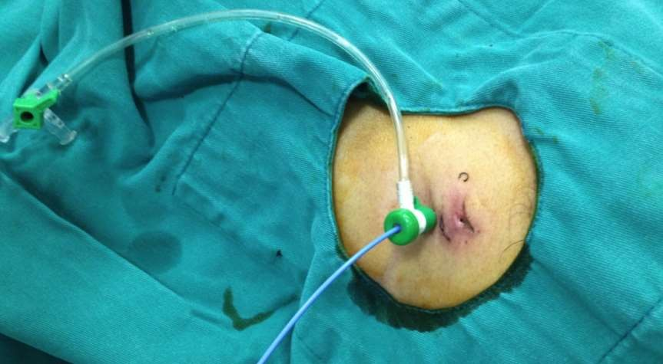 Dẫn lưu với pigtail