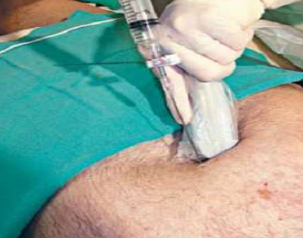 Siêu âm hướng dẫn