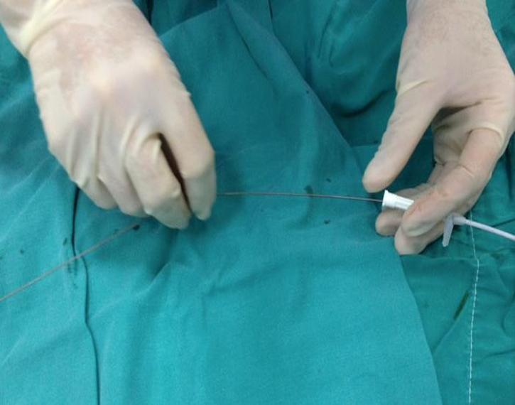 Kết nối chai dẫn lưu 1