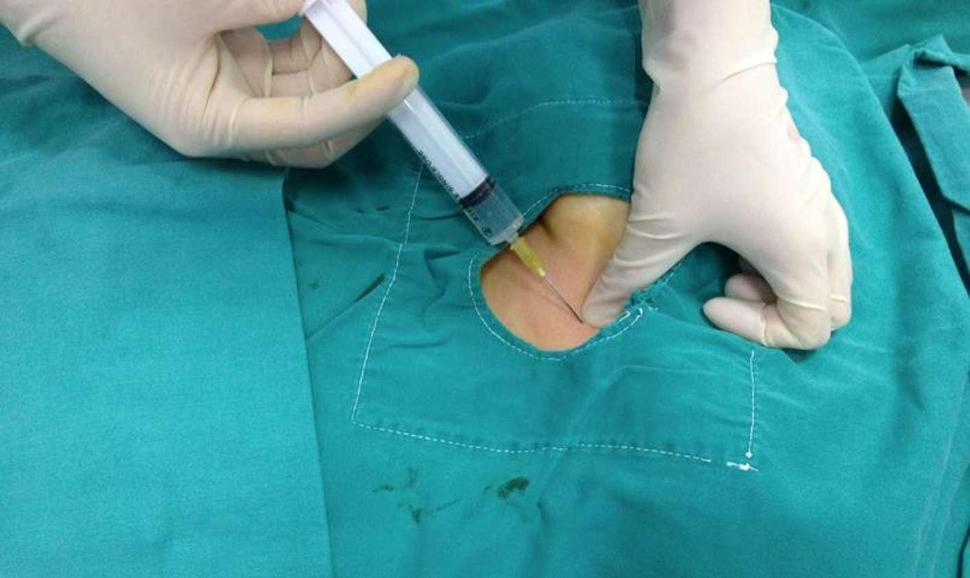 Gây tê và thăm dò