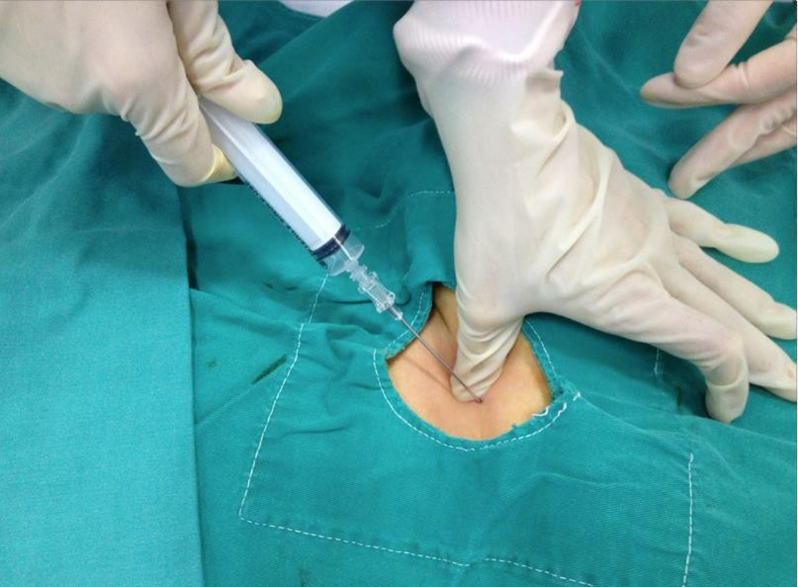 Chọc bằng kim chọc mạch