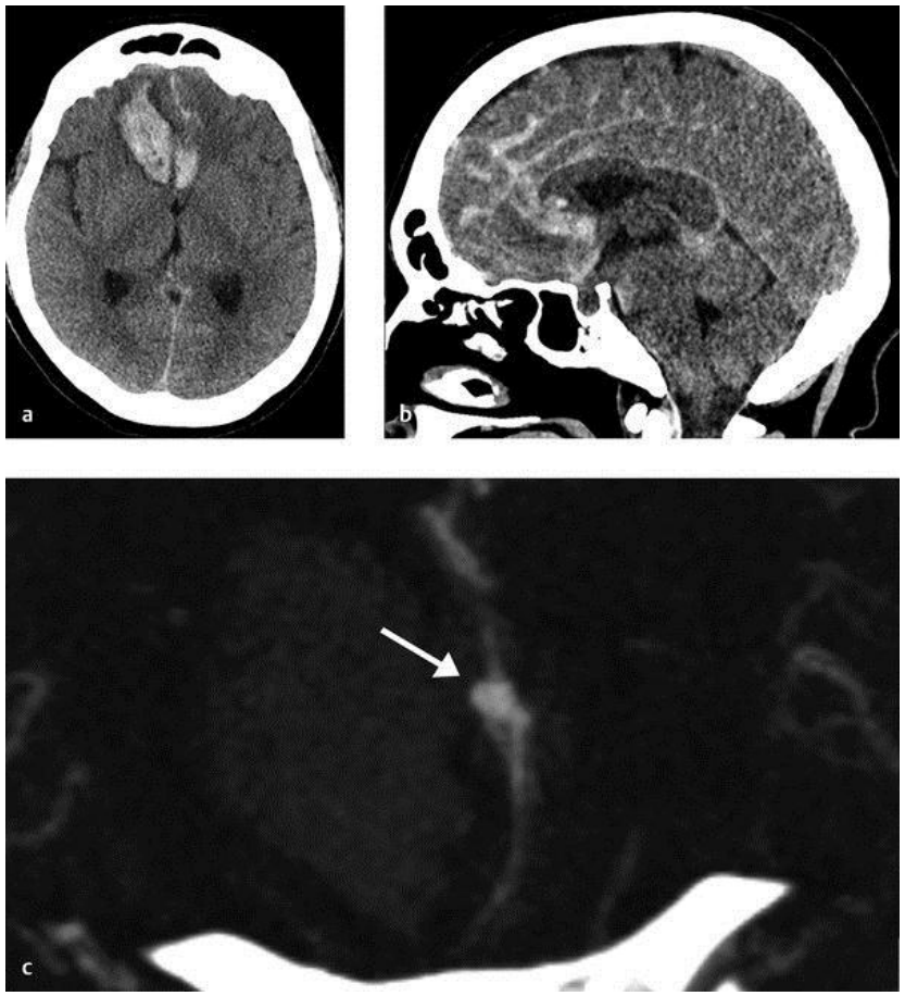 Hình ảnh xuất huyết dưới nhện và trong nhu mô não do phình mạch não vỡ