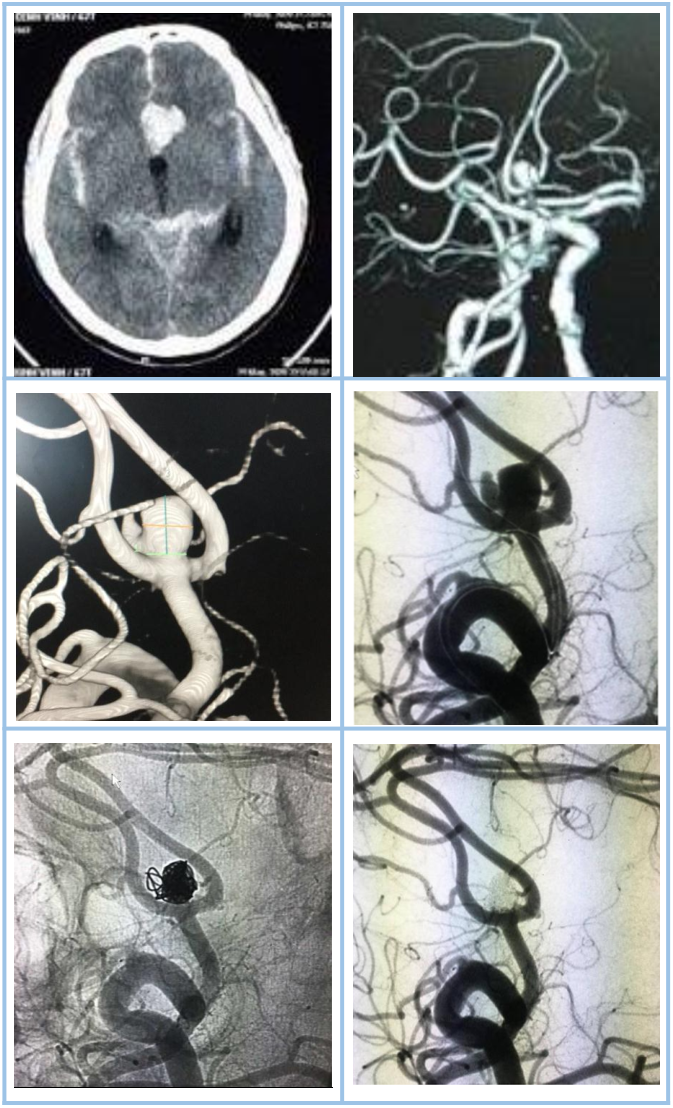 Túi phình động mạch