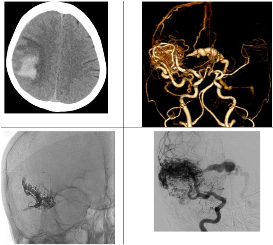 Dị dạng mạch AVM vỡ