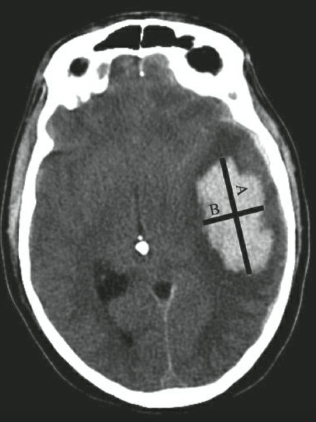 Tính thể tích khối máu tụ