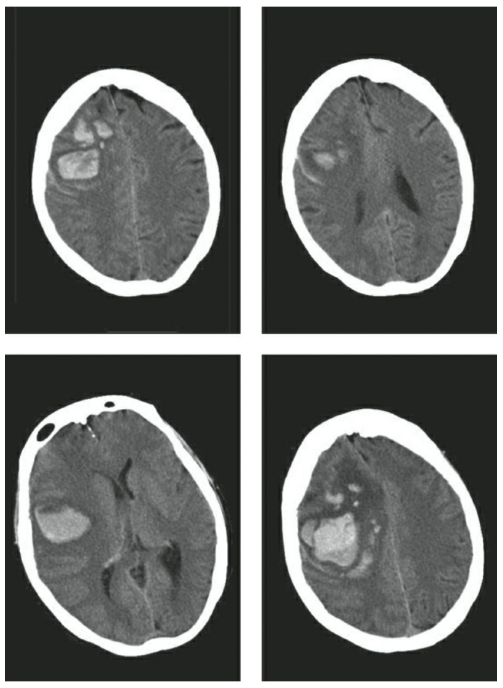 Xuất huyết trong não liên quan đến bệnh lý não dạng bột (CAA)
