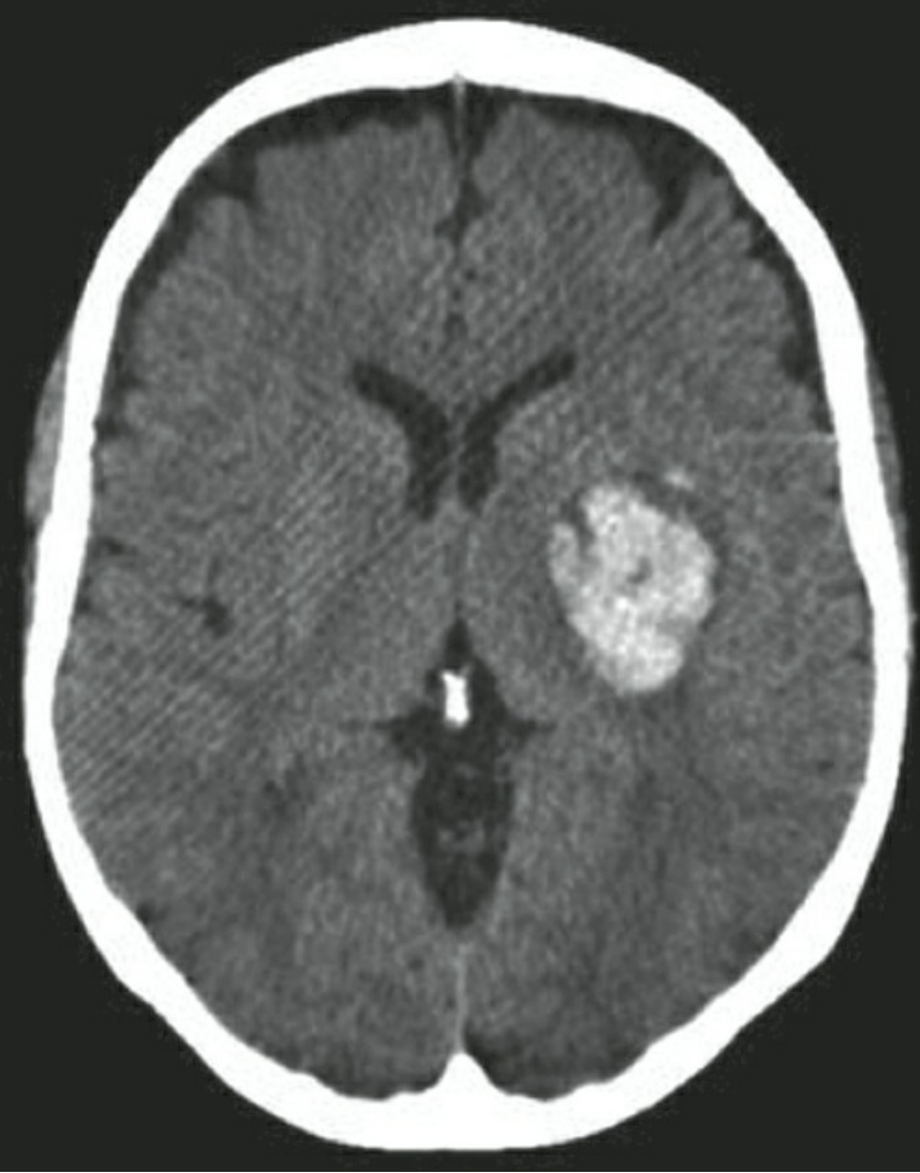Xuyết huyết não do tăng huyết áp. Xuất huyết não trái cấp tính trên CT đầu không thuốc cản quang.
