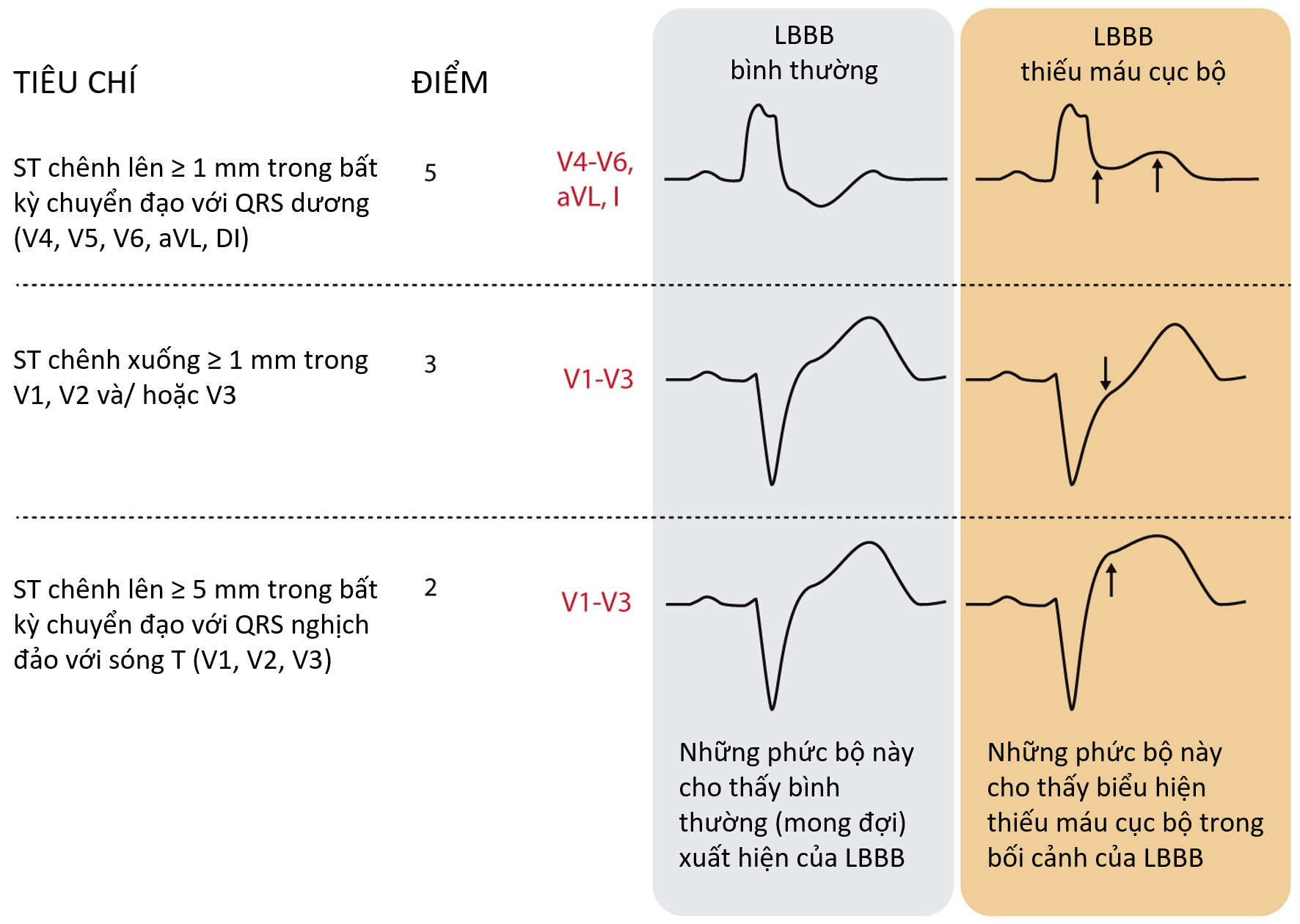 Tiêu chí Sgarbossa