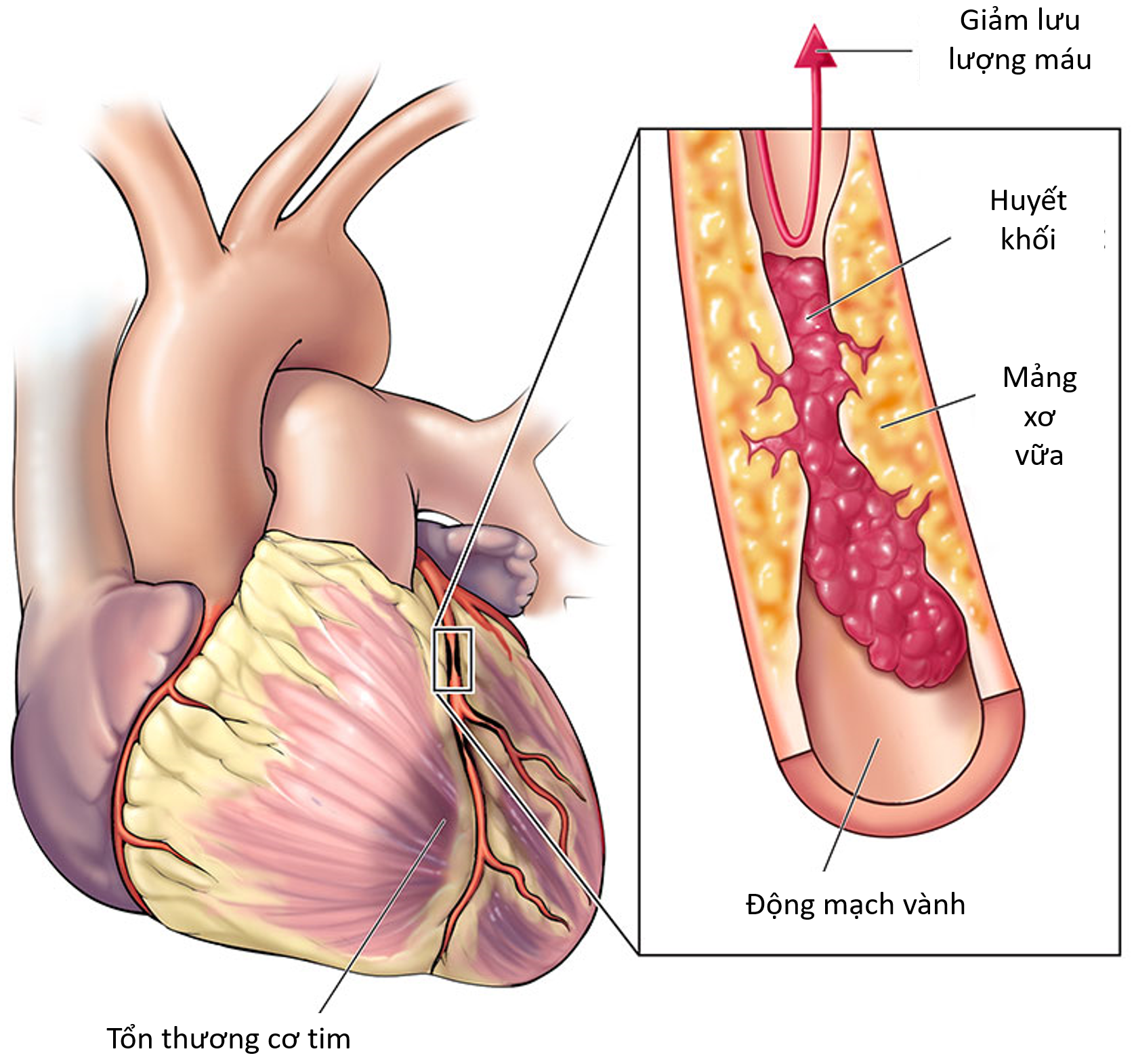 Nguyên nhân nhồi máu cơ tim