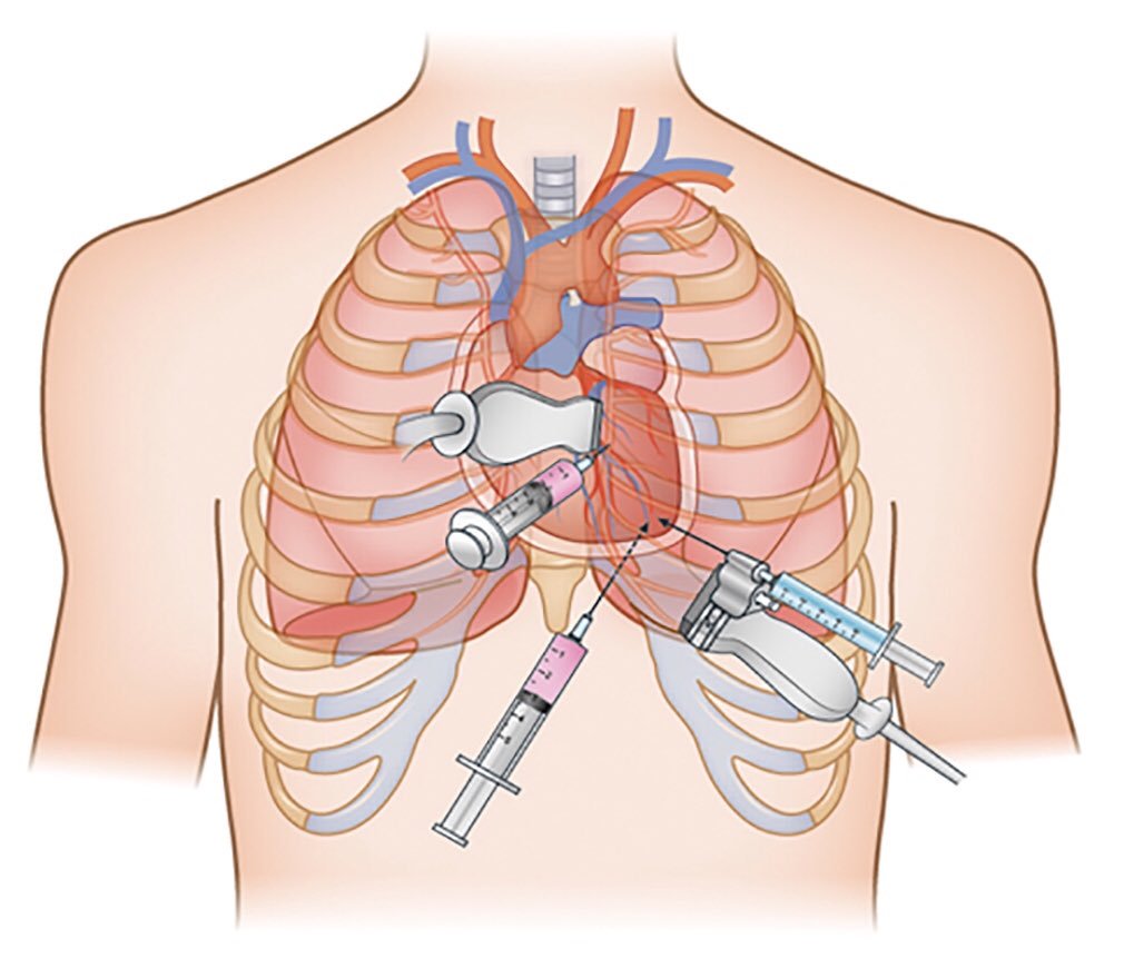 Vị trí chọc hút dịch màng tim cấp cứu